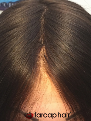 alopecia parrucche