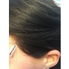 Protesi alopecia areata