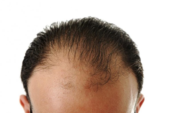 protesi capelli on line