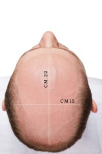 protesi capelli online
